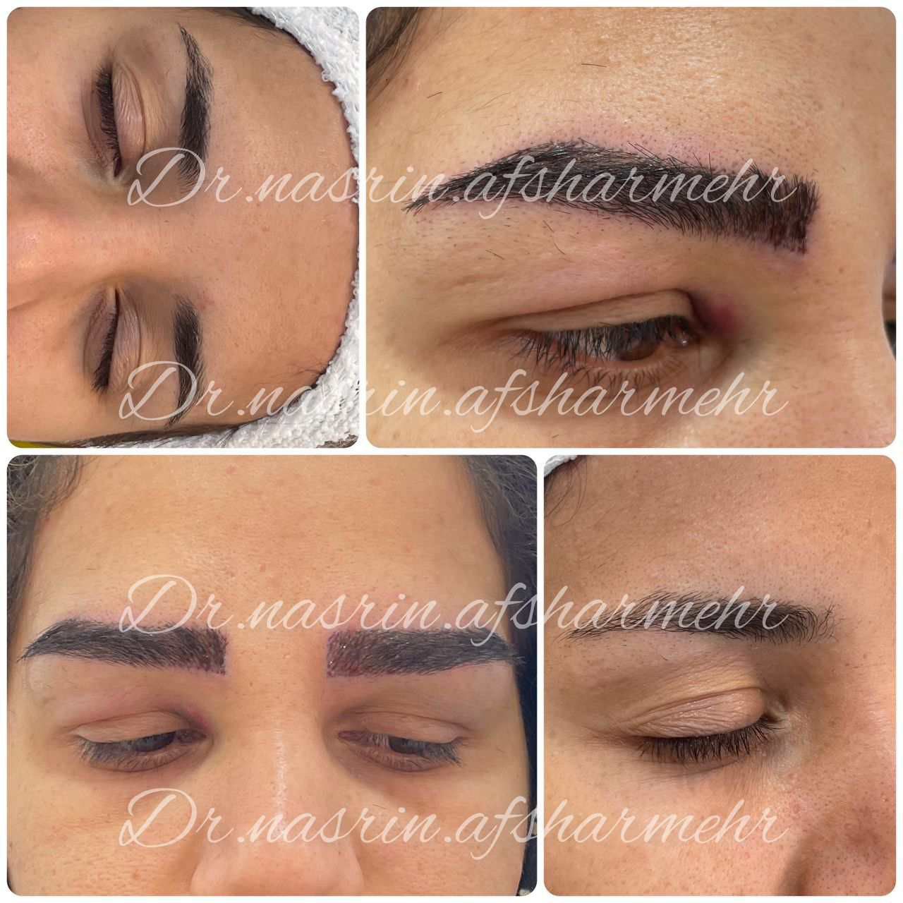 کاشت ابرو دکتر افشار مهر