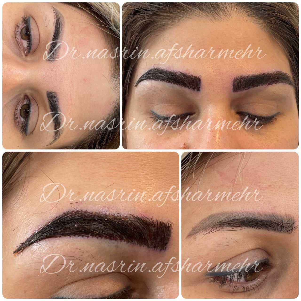 کاشت ابرو دکتر افشار مهر