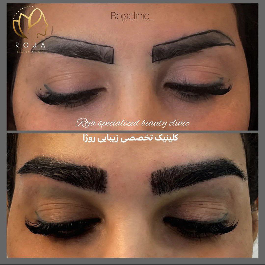 کاشت ابرو دکتر افشار مهر