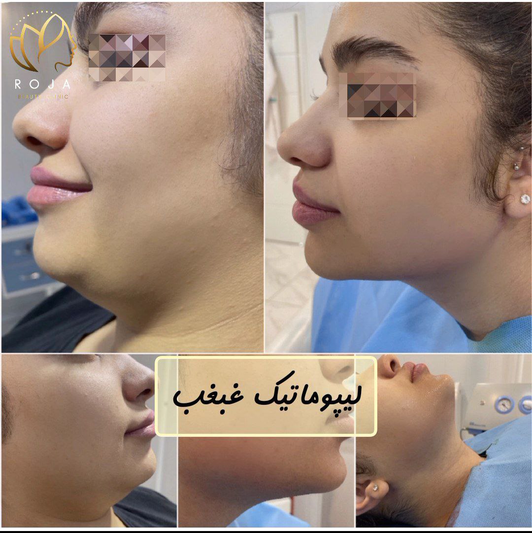 لیپوماتیک غبغب دکتر افشار مهر