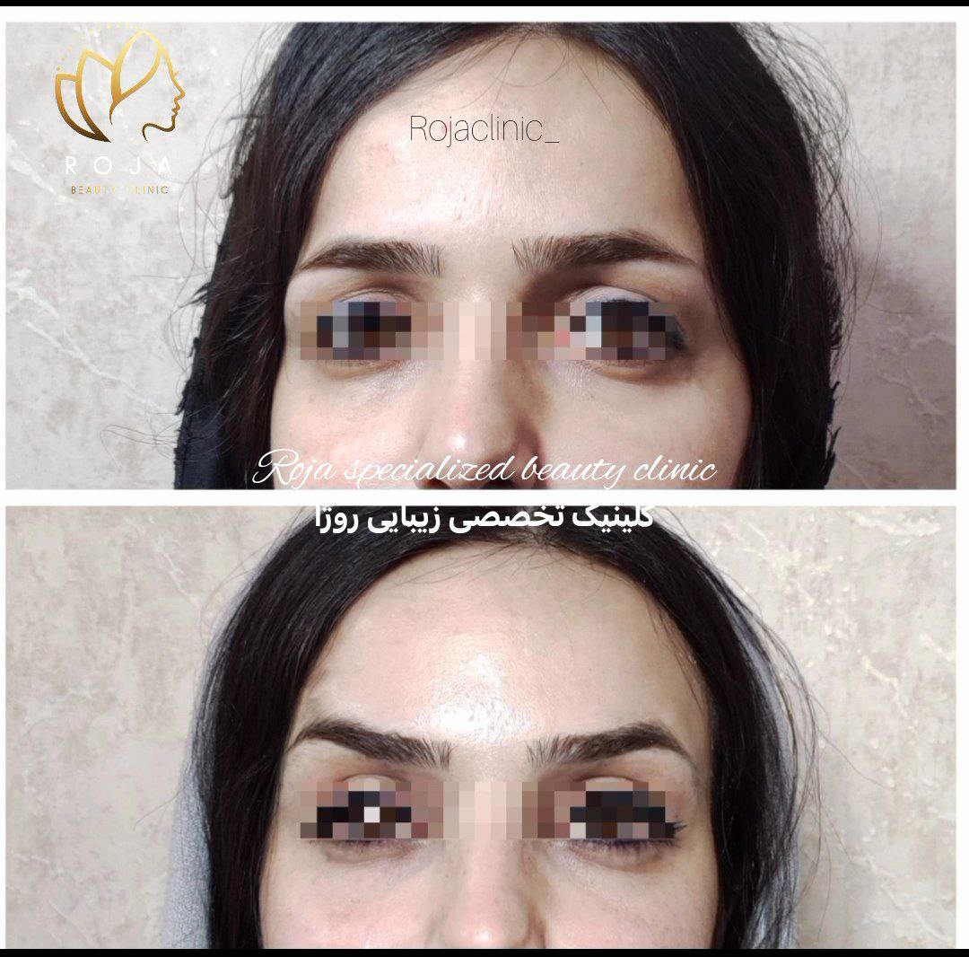 لیفت شقیقه دکتر معینی