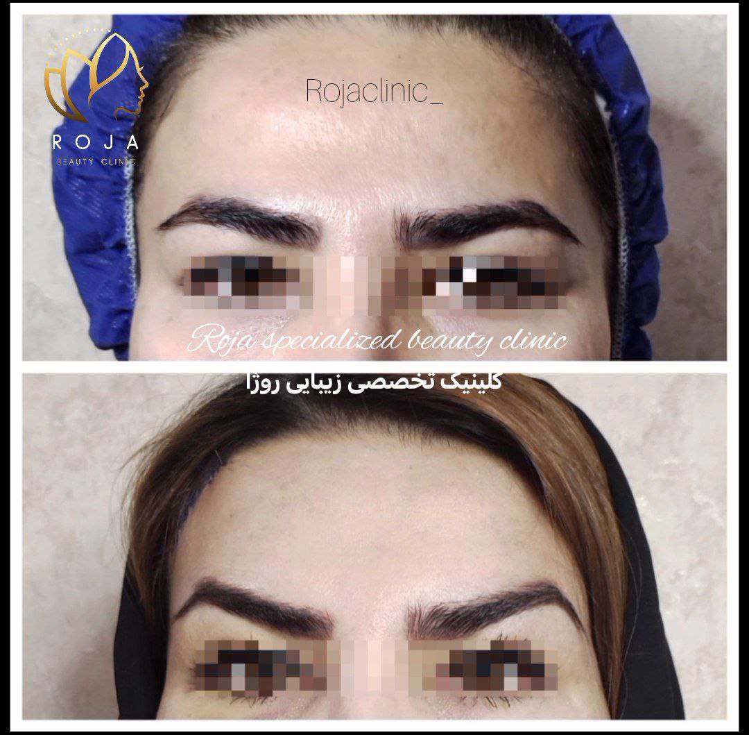 لیفت شقیقه دکتر معینی