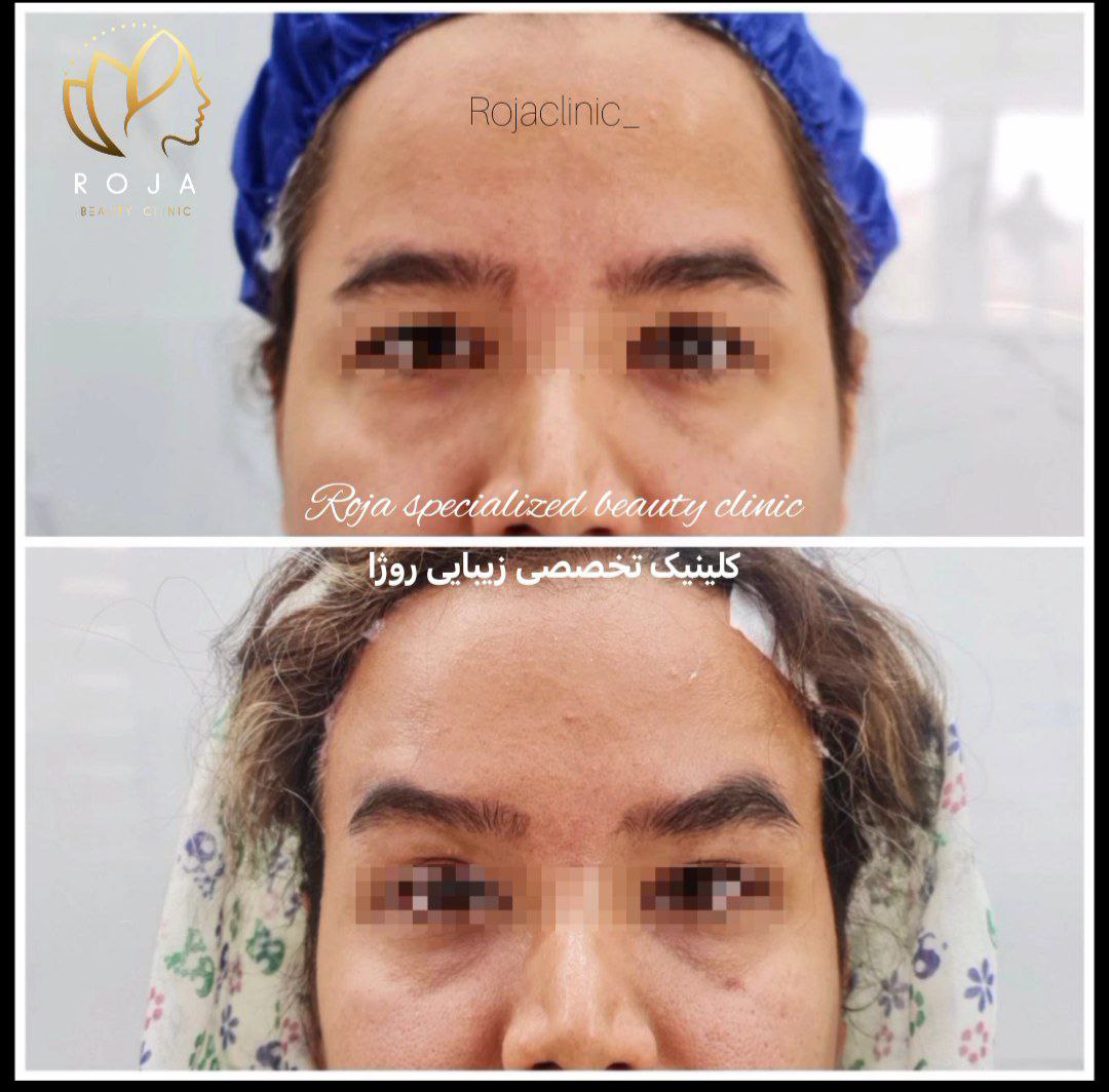 لیفت شقیقه دکتر معینی