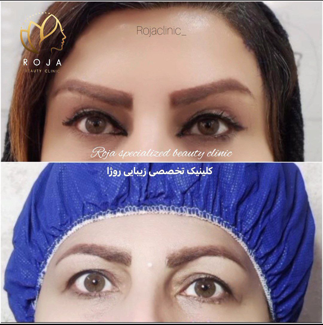 لیفت شقیقه دکتر معینی
