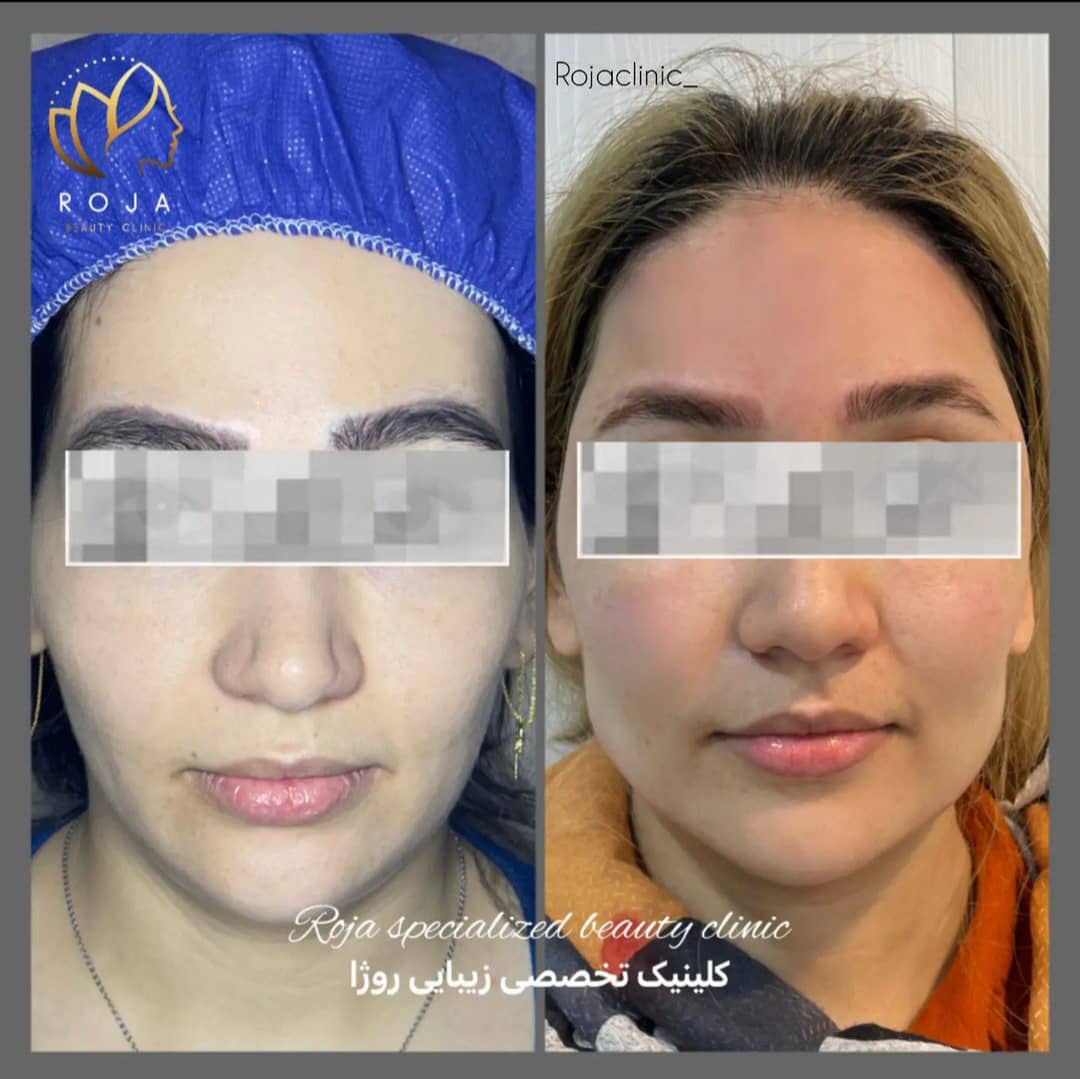 تزریق چربی دکتر افشار مهر