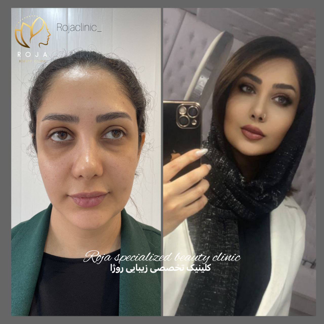 تزریق چربی دکتر افشار مهر