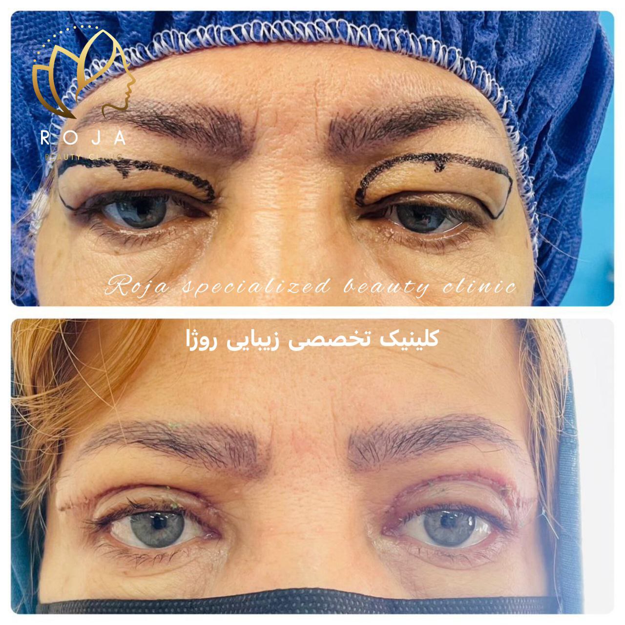 بلفاروپلاستی دکتر توکلی