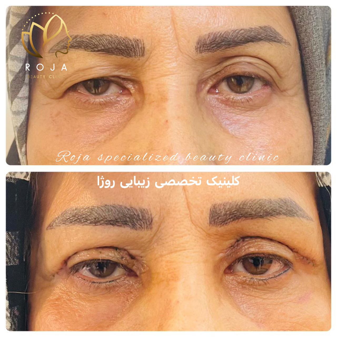 بلفاروپلاستی دکتر توکلی